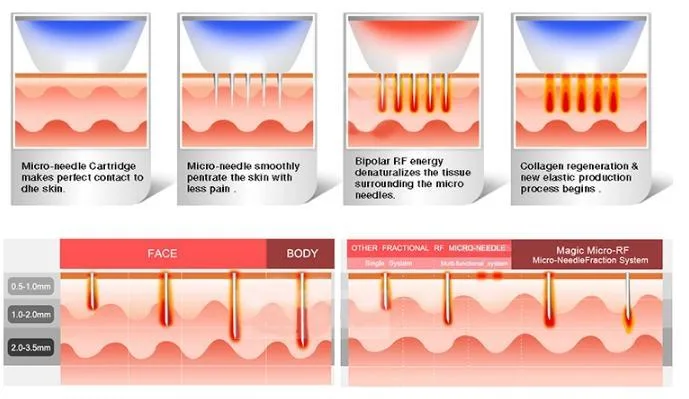 RF Skin Rejuvenation Fractional Microneeding Skin Lifting Wrinkle Removal Machine Beauty Device